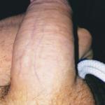 Limp penis